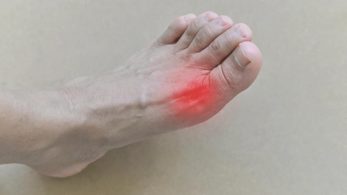 gejala asam urat pada kaki
